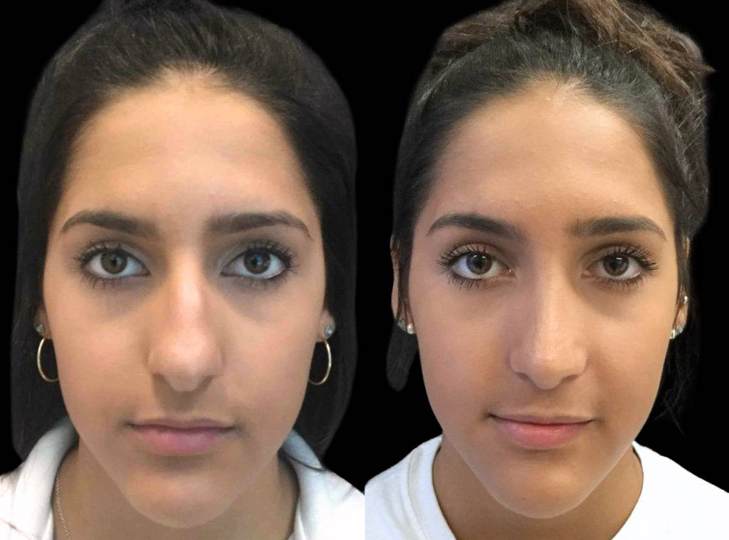 16-year-old-female-rhinoplasty-front-view.jpg