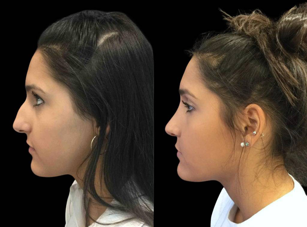 16-year-old-female-rhinoplasty-side-view.jpg