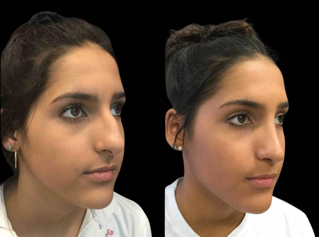 16-year-old-female-rhinoplasty-three-quarters-view.jpg