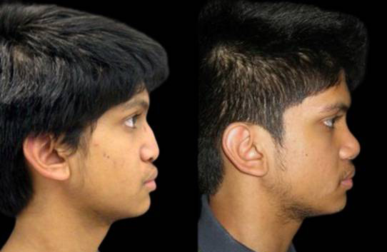 16-year-old-male-rhinoplasty-before-and-after-side-view.jpg