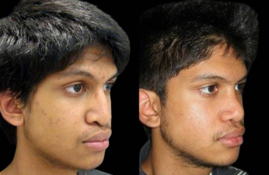 16-year-old-male-rhinoplasty-before-and-after-three-quarters-view.jpg