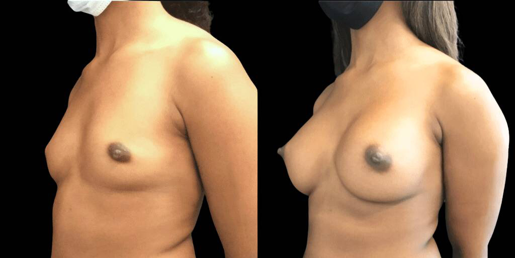 This is a 27-year-old female that has had a breast augmentation and implant showing the before and after's side-by-side