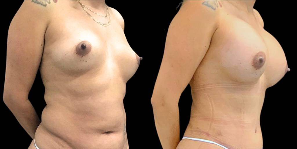 17-year-old-female-mommy-makeover-body-before-and-after-three-quarters-view-.jpg
