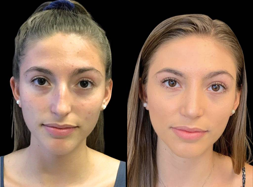 17-year-old-female-rhinoplasty-before-and-after-front-view-.jpg