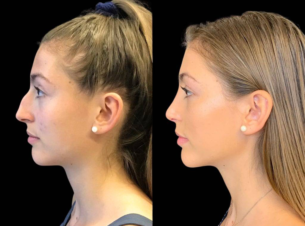 17-year-old-female-rhinoplasty-before-and-after-side-view-.jpg