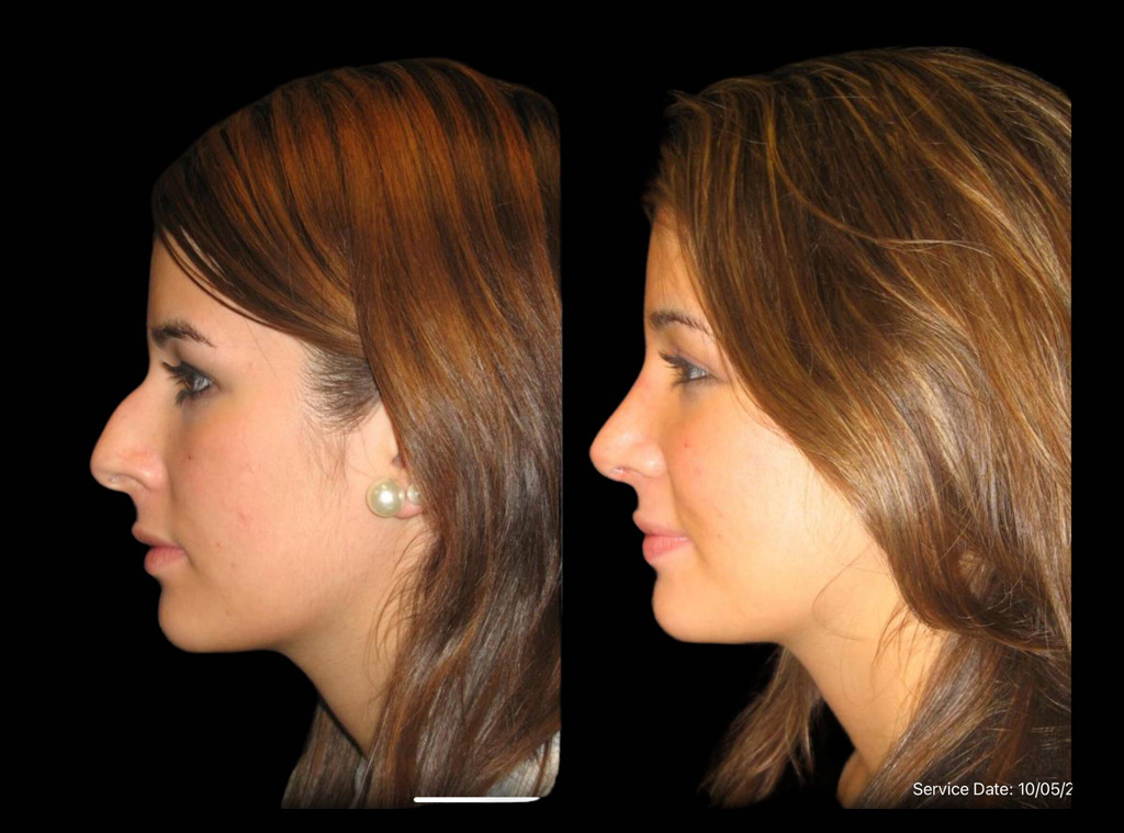 17-year-old-female-rhinoplasty-before-and-after-side-view-1-1.jpg