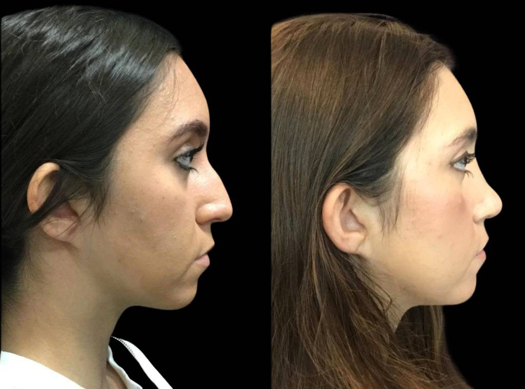 17-year-old-female-rhinoplasty-before-and-after-side-view.jpg