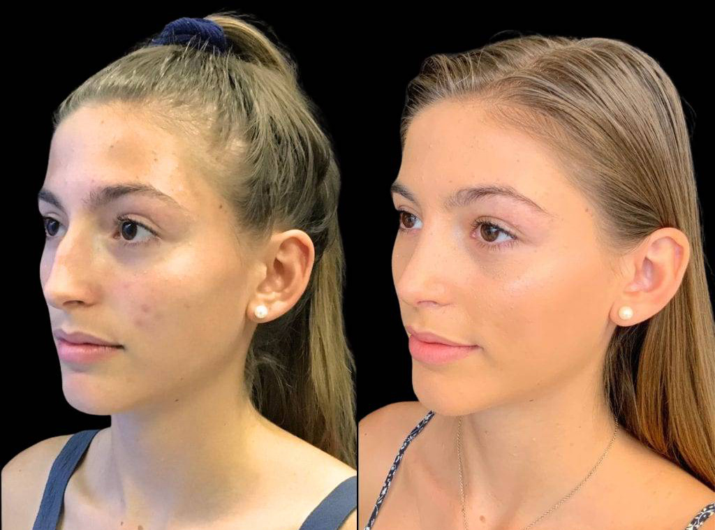 17-year-old-female-rhinoplasty-before-and-after-three-quarters-view-.jpg