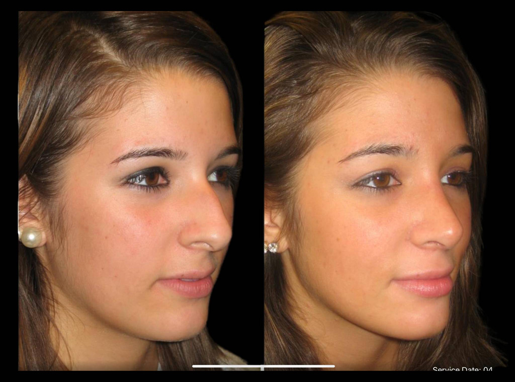 17-year-old-female-rhinoplasty-before-and-after-three-quarters-view-1-1.jpg