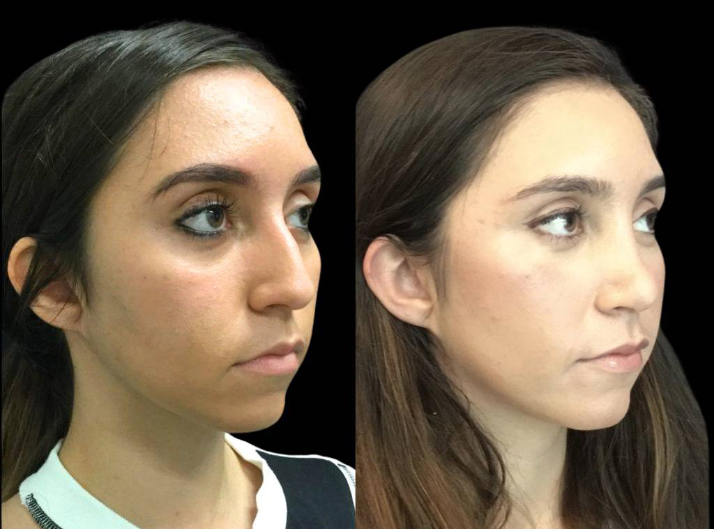 17-year-old-female-rhinoplasty-before-and-after-three-quarters-view-1.jpg