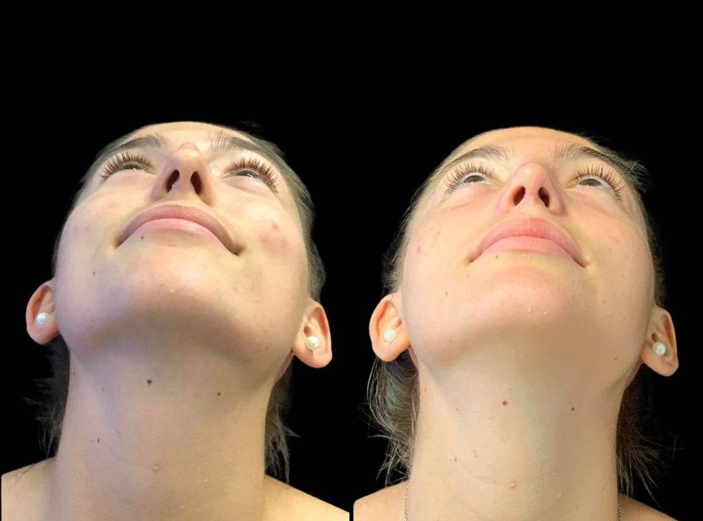 17-year-old-female-rhinoplasty-before-and-after-worms-eye-view-.jpg