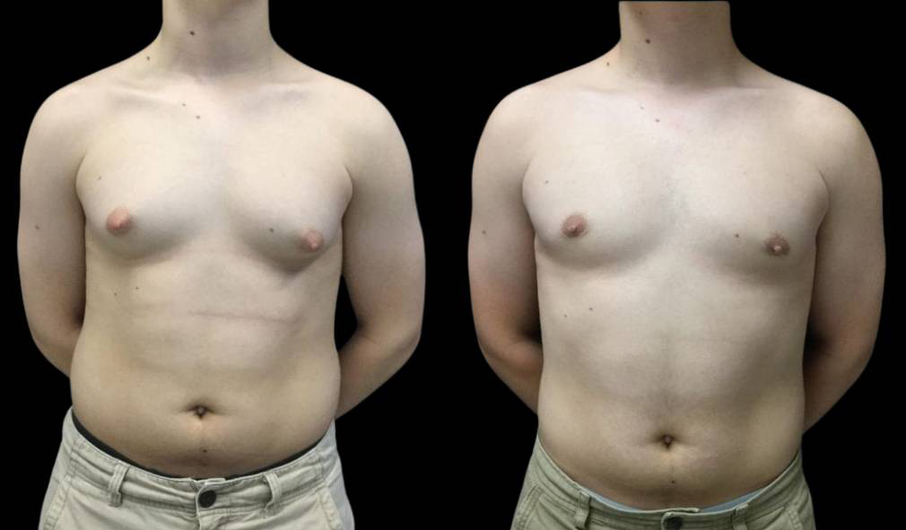17-year-old-male-breast-reduction-before-and-after-front-view-21818.jpg