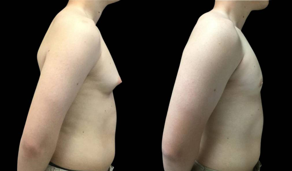 17-year-old-male-breast-reduction-before-and-after-side-view.jpg
