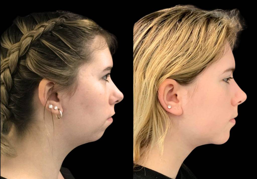 18-year-old-female-chin-implant-before-and-after-side-view-.jpg