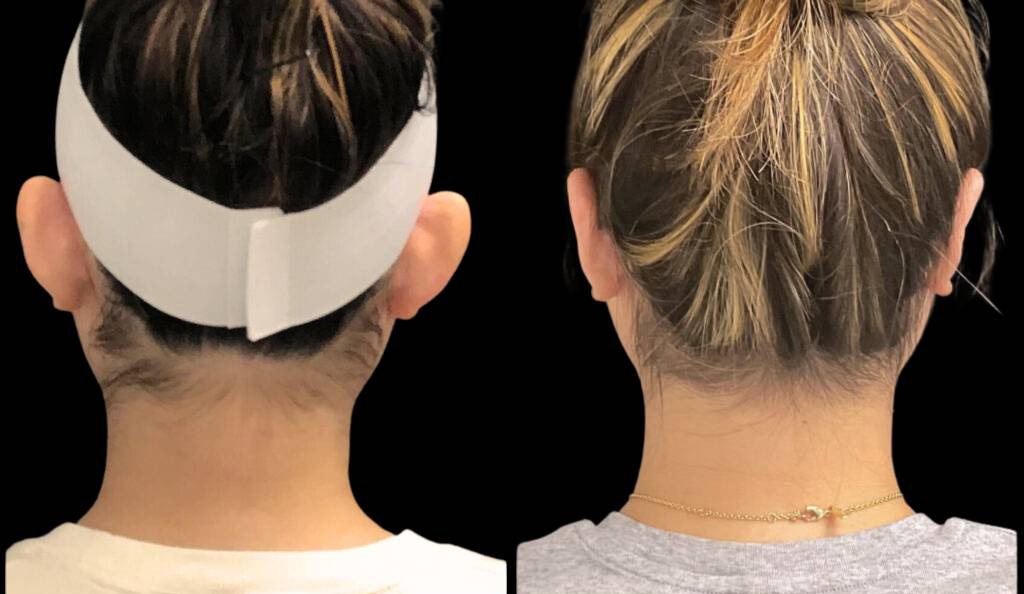 18-year-old-female-ear-pinning-before-and-after-front-view-.jpg