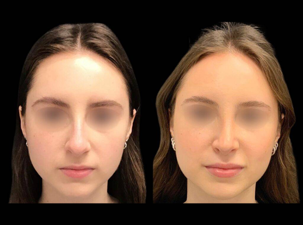 18-year-old-female-rhinoplasty-before-and-after-front-view-1.jpg