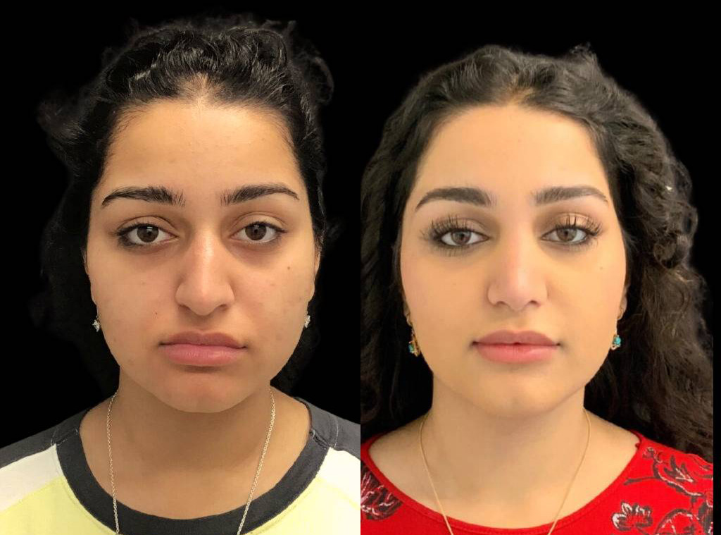 18-year-old-female-rhinoplasty-before-and-after-front-view.jpg