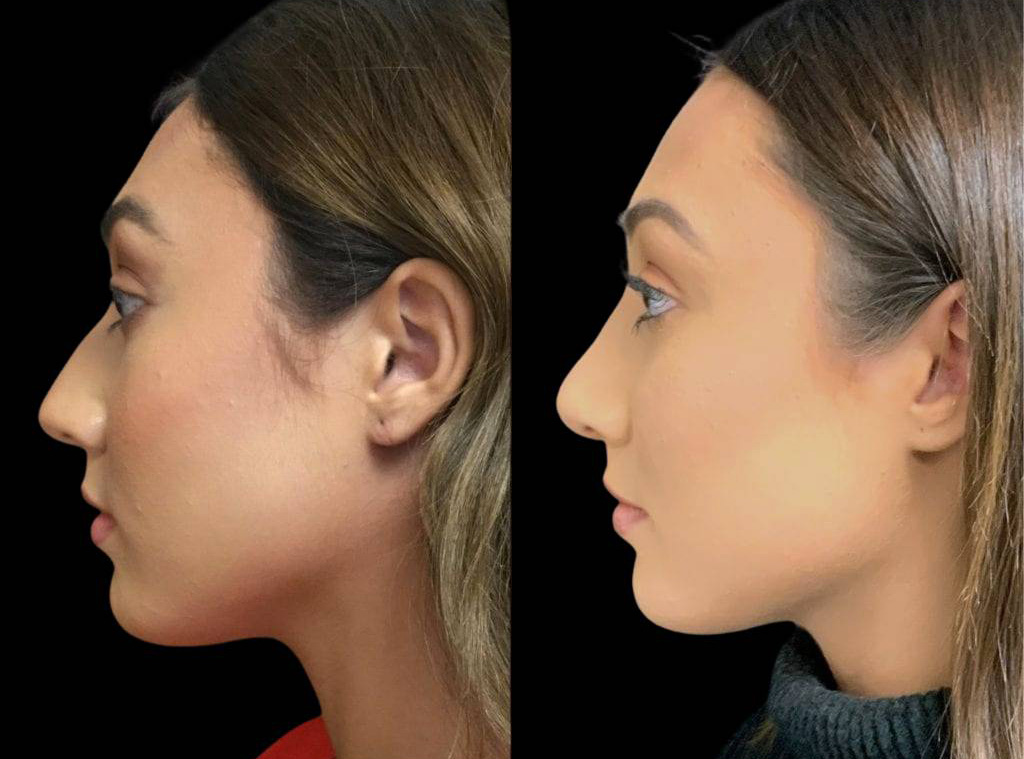 18-year-old-female-rhinoplasty-before-and-after-side-view-.jpg