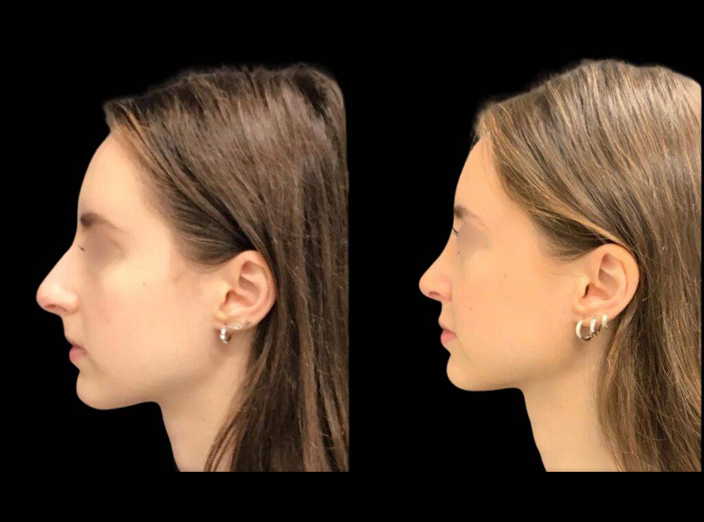 18-year-old-female-rhinoplasty-before-and-after-side-view-1.jpg