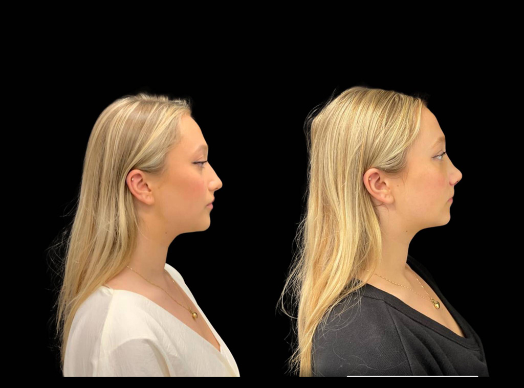 18-year-old-female-rhinoplasty-before-and-after-side-view-3.jpg