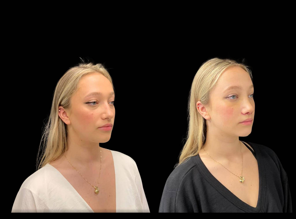 18-year-old-female-rhinoplasty-before-and-after-three-quarter-view.jpg