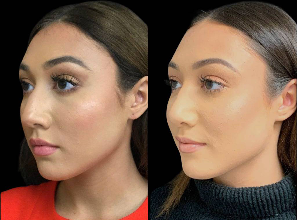 18-year-old-female-rhinoplasty-before-and-after-three-quarters-view-.jpg