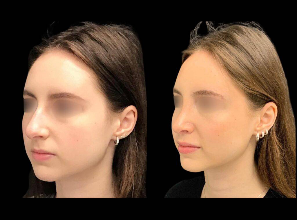 18-year-old-female-rhinoplasty-before-and-after-three-quarters-view-1.jpg