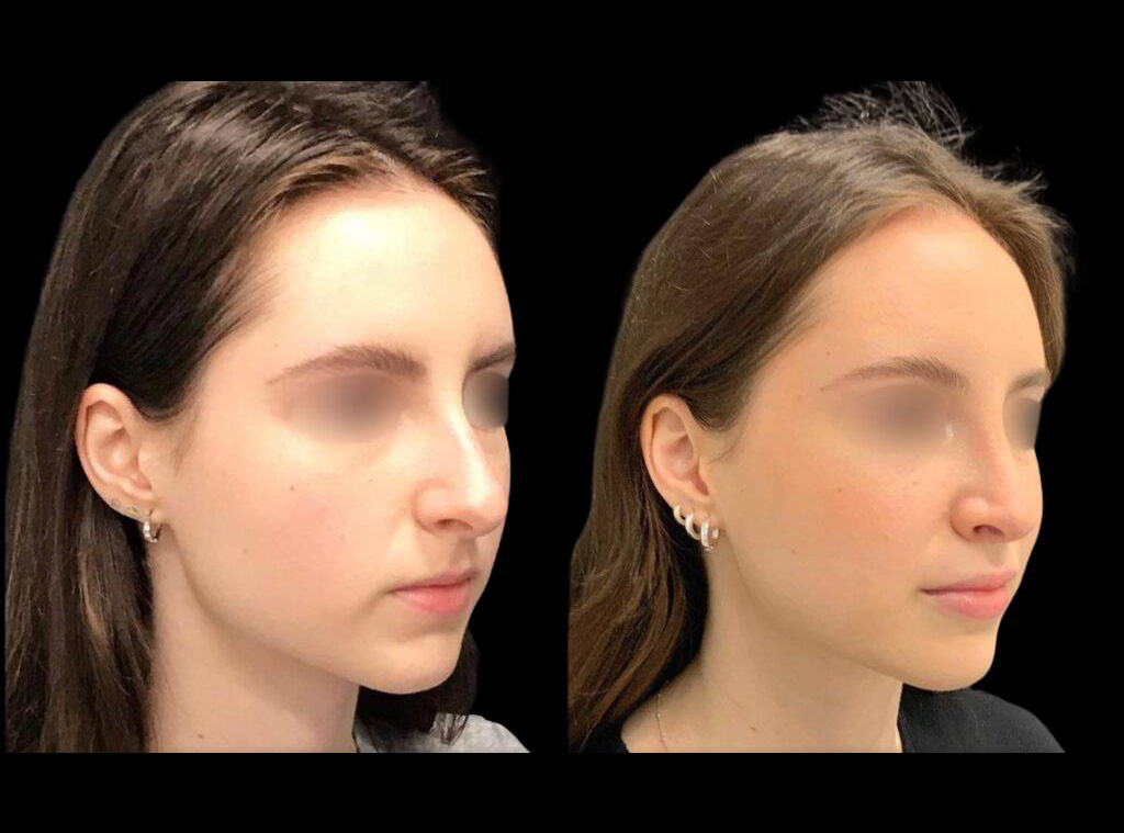 18-year-old-female-rhinoplasty-before-and-after-three-quarters-view-2-1.jpg