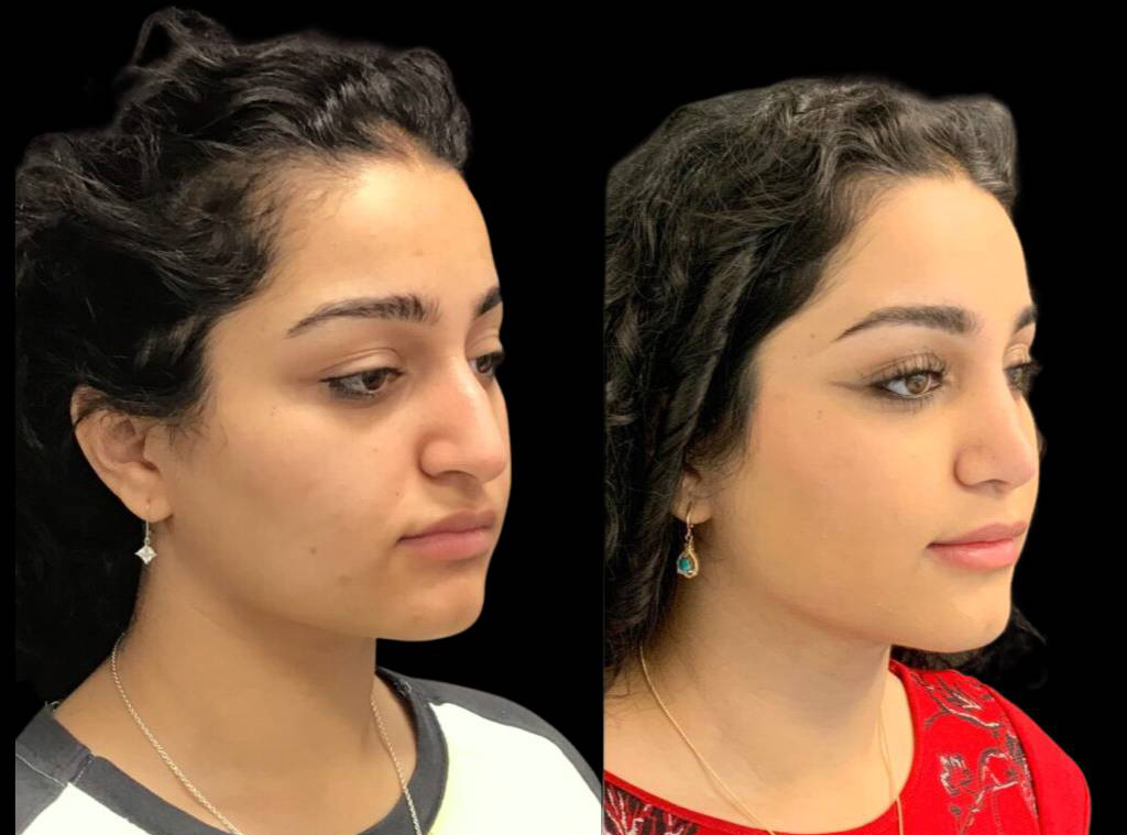 18-year-old-female-rhinoplasty-before-and-after-three-quarters-view.jpg