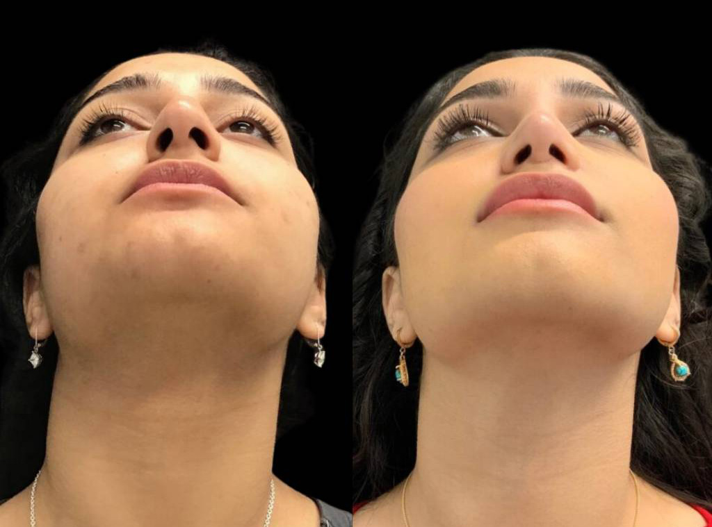 18-year-old-female-rhinoplasty-before-and-after-worms-eye-view.jpg