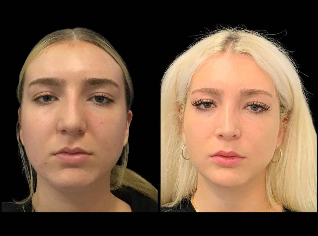 18-year-old-female-rhinoplasty-front-view.jpg