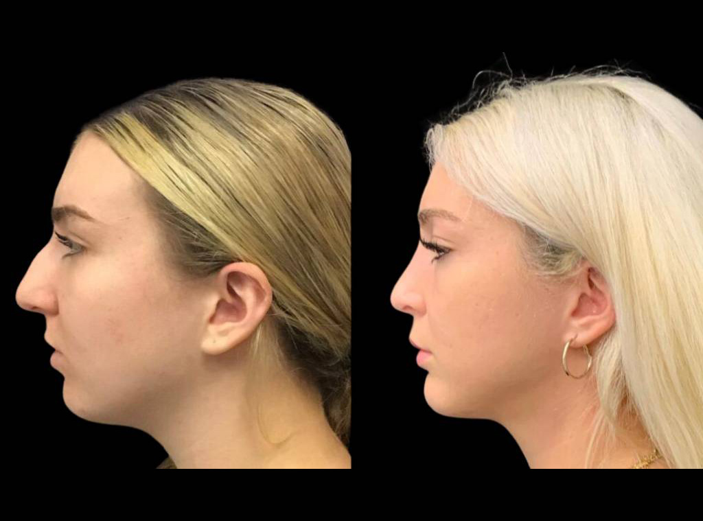 18-year-old-female-rhinoplasty-side-view-1.jpg
