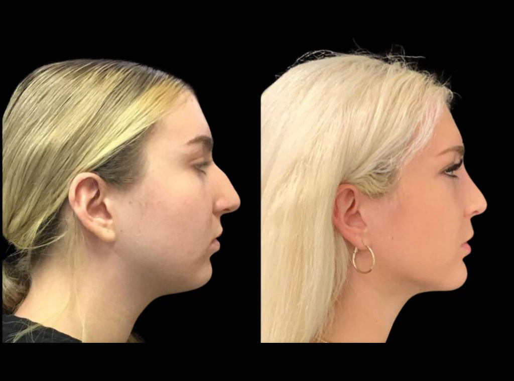 18-year-old-female-rhinoplasty-side-view.jpg