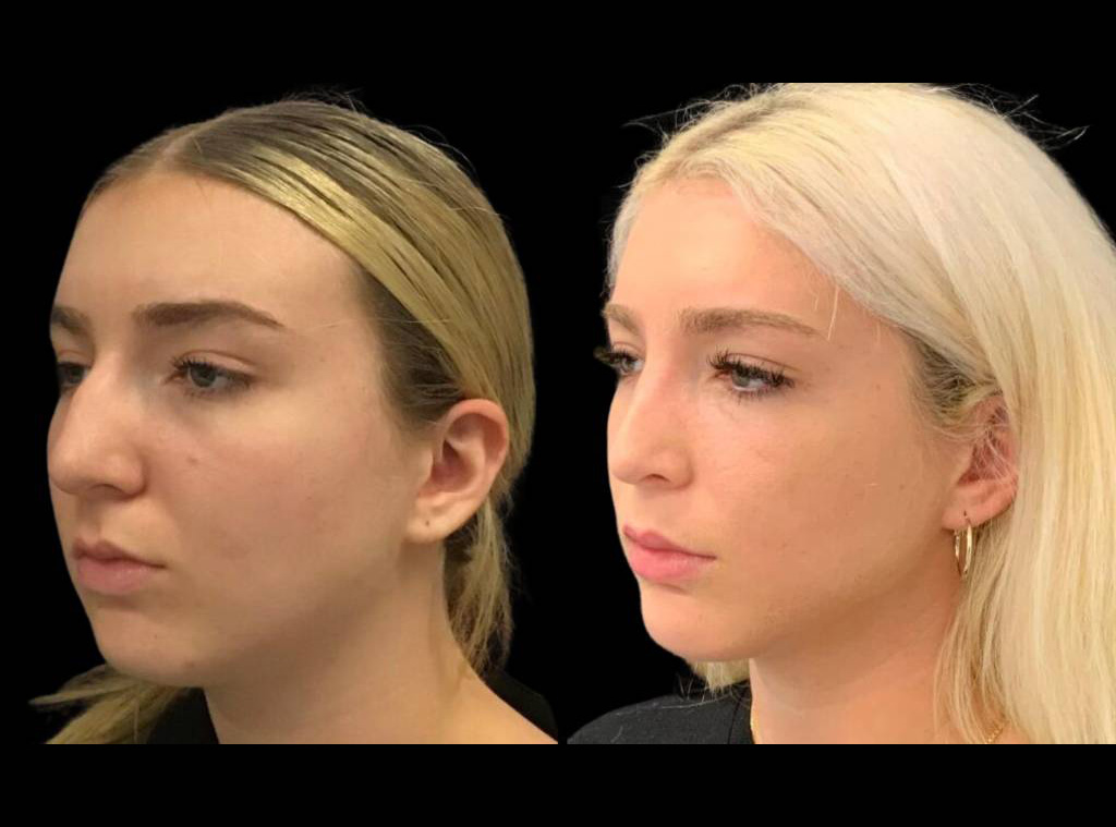 18-year-old-female-rhinoplasty-three-quarters-view-1.jpg
