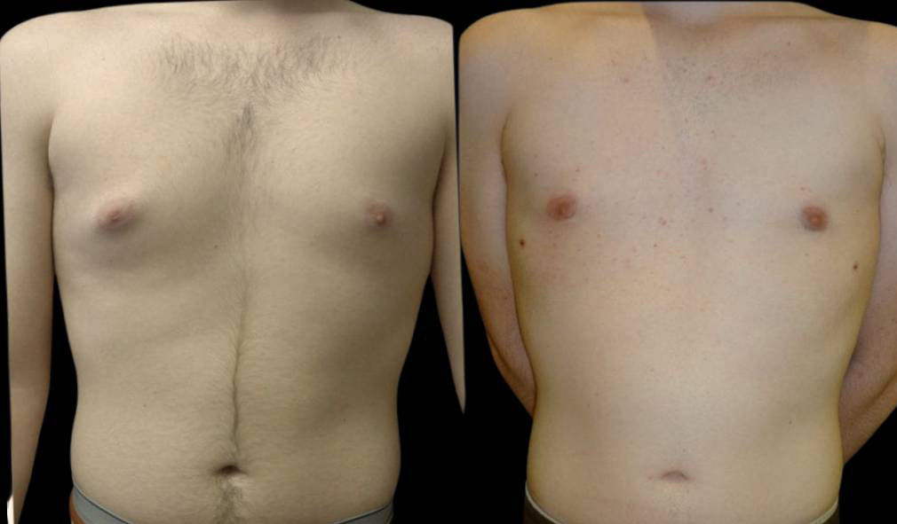 18-year-old-male-breast-reduction-before-and-after-front-view-16589.jpg
