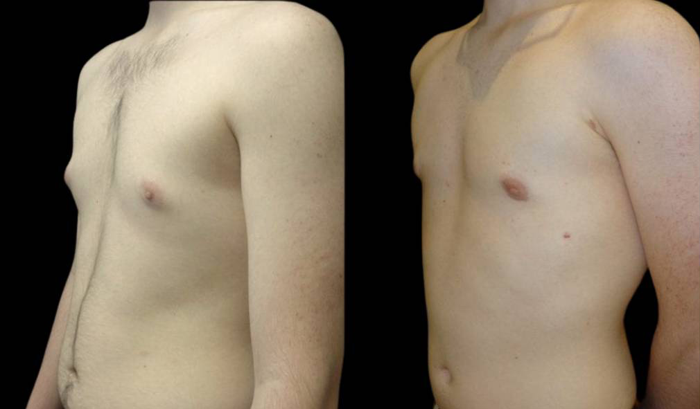 18-year-old-male-breast-reduction-before-and-after-three-quarter-view.jpg