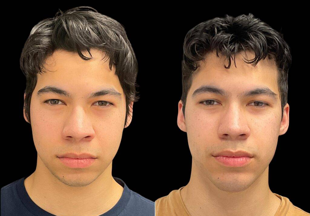 18-year-old-male-chin-implant-before-and-after-front-view-.jpg