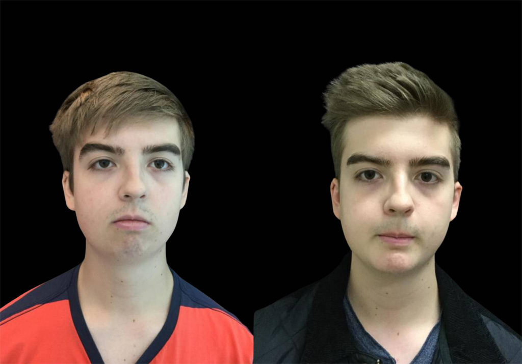 18-year-old-male-chin-implant-before-and-after-front-view-1.jpg