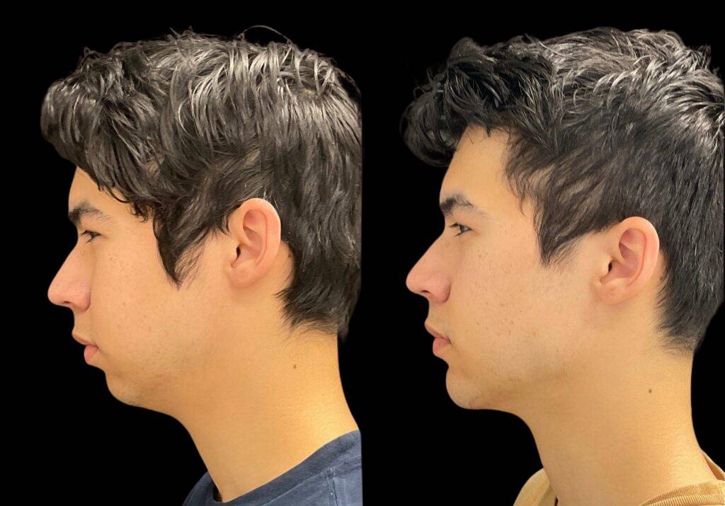 18-year-old-male-chin-implant-before-and-after-side-view-.jpg