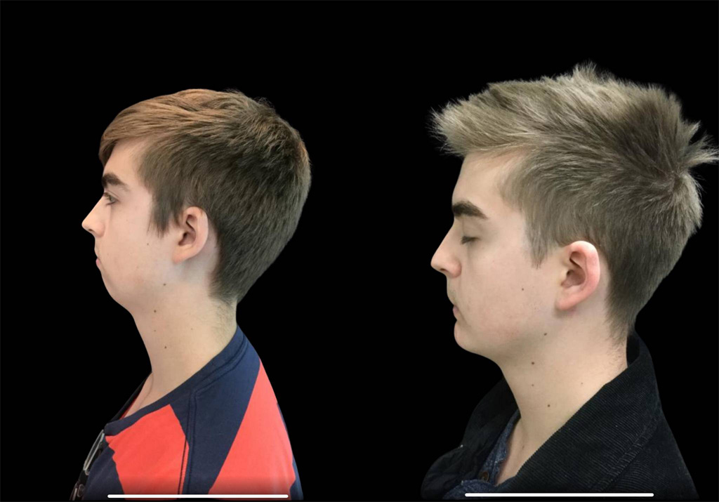 18-year-old-male-chin-implant-before-and-after-side-view-2.jpg