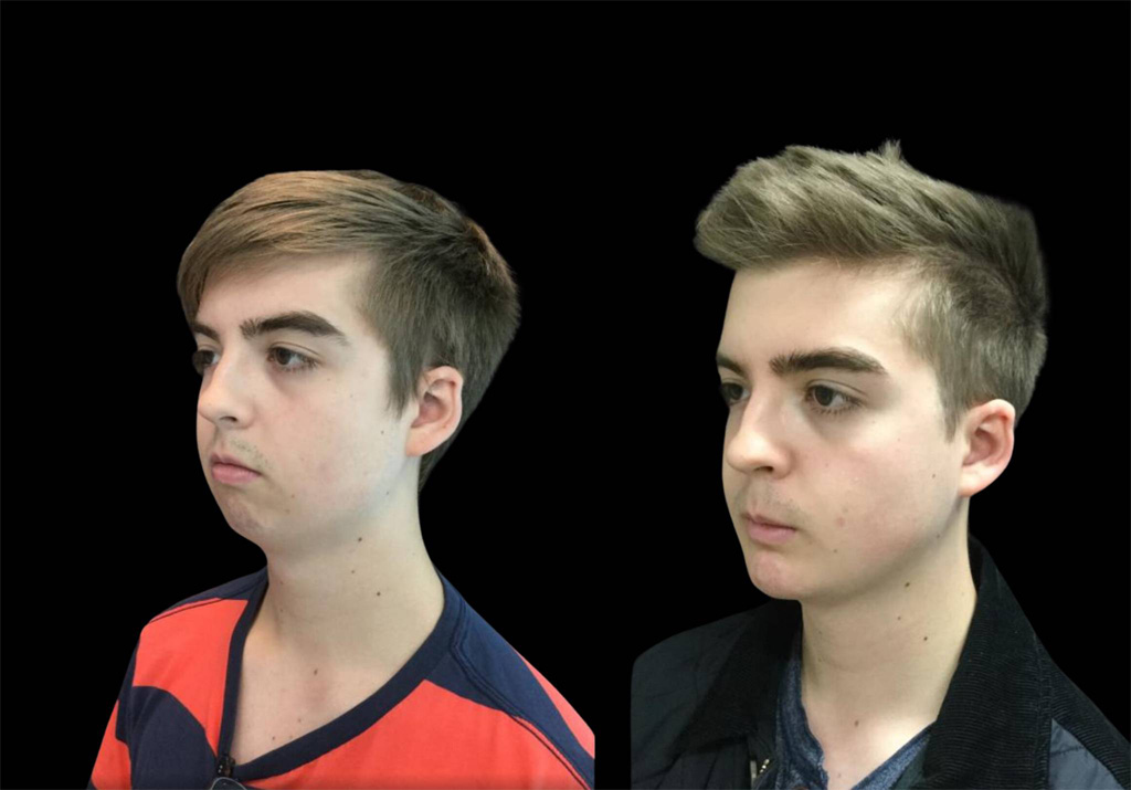 18-year-old-male-chin-implant-before-and-after-three-quarter-view-.jpg