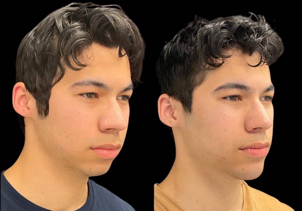 18-year-old-male-chin-implant-before-and-after-three-quarters-view-.jpg