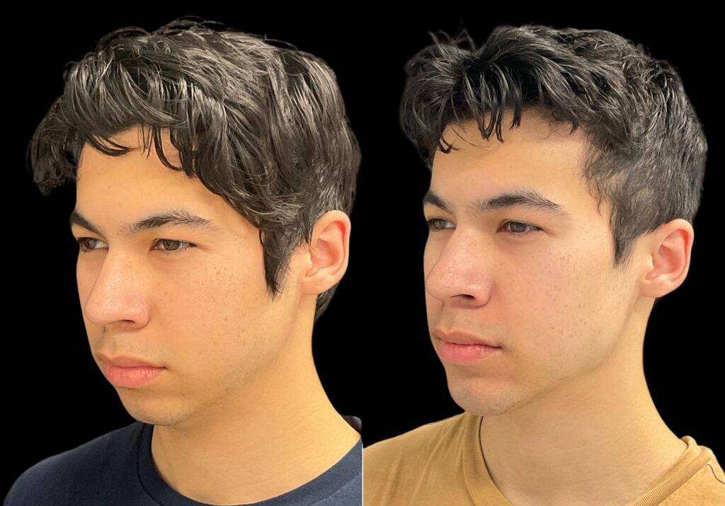 18-year-old-male-chin-implant-before-and-after-three-quarters-view-1.jpg