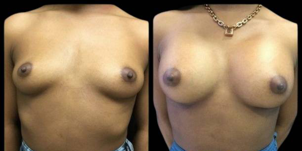 This is a 19-year-old female that has had a breast augmentation and implant showing the before and after's side-by-side