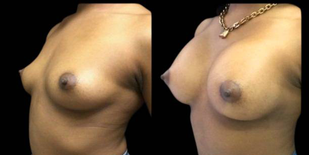 This is a 19-year-old female that has had a breast augmentation and implant showing the before and after's side-by-side