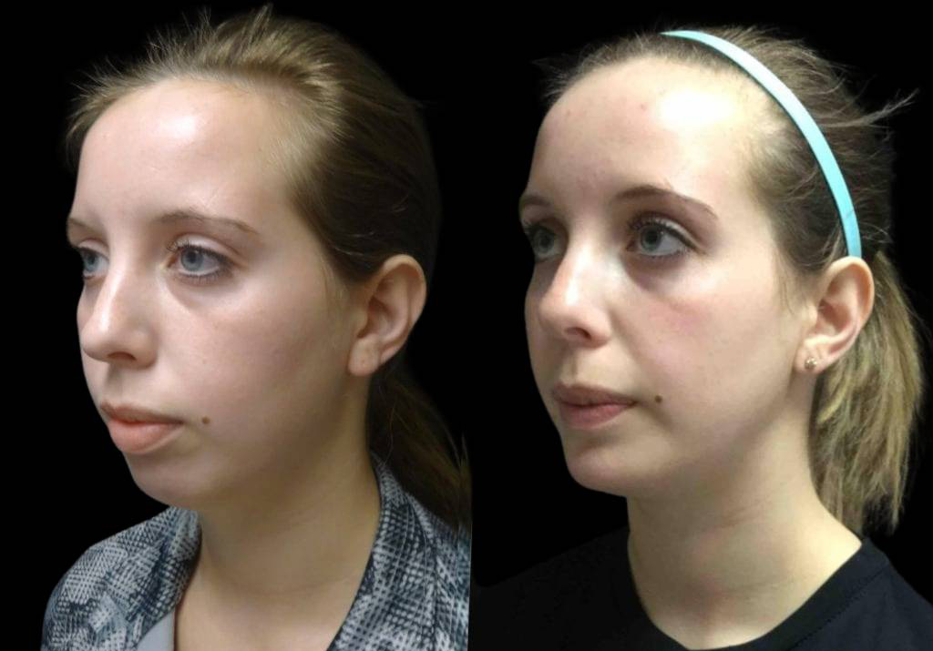 19-year-old-female-chin-implant-before-and-after-side-view.jpg