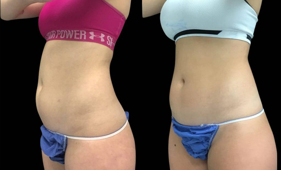 19-year-old-female-coolsculpting-before-and-after-three-quarter-view-29374.jpg