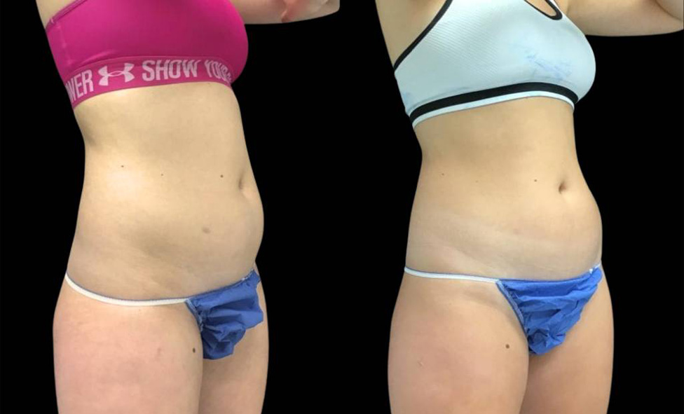 19-year-old-female-coolsculpting-before-and-after-three-quarter-view.jpg