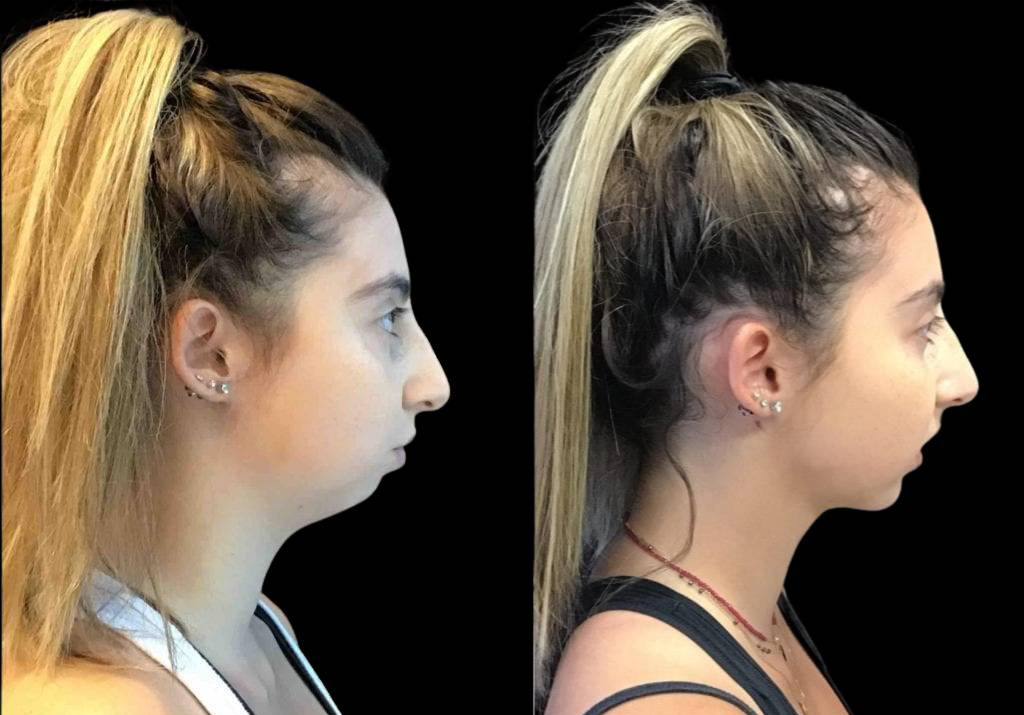 19-year-old-female-neck-lipo-before-and-after-side-view-.jpg