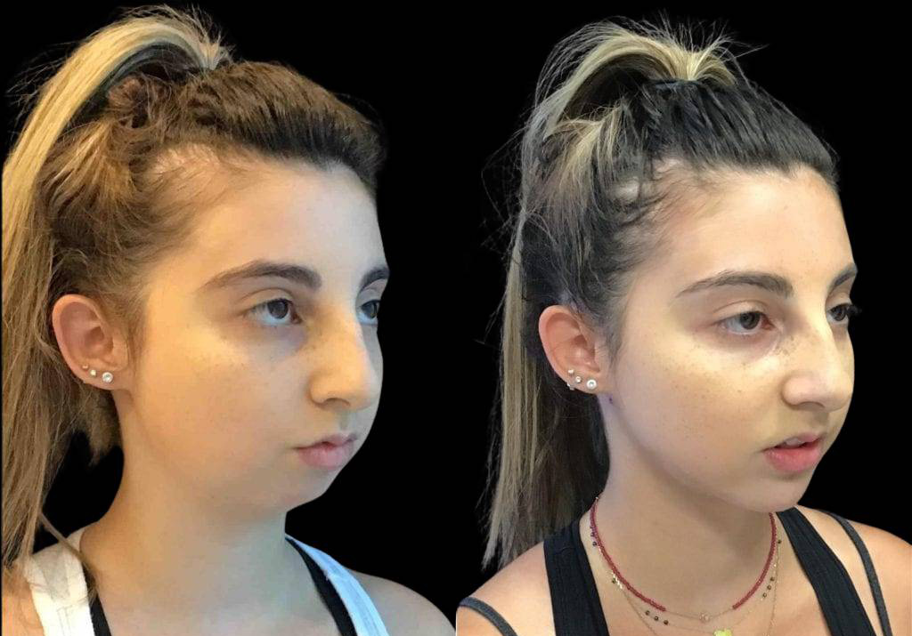 19-year-old-female-neck-lipo-before-and-after-three-quarters-view-.jpg